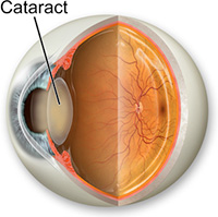 cataracts