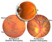 diabetic-eye-disease