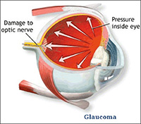 glaucoma